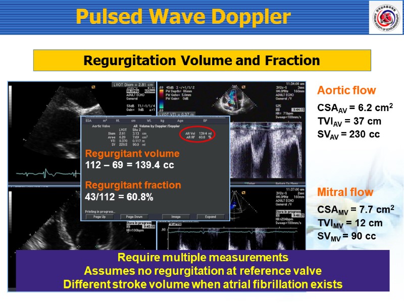 Pulsed Wave Doppler Regurgitation Volume and Fraction Require multiple measurements Assumes no regurgitation at